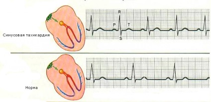 EKG sinus ritmus - mi ez