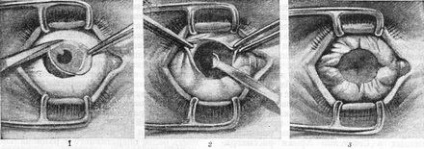 Kizsigerelésére a szem (exenteration) (tartalom eltávolításával művelet) Kizsigerelésére a szem (exenteration)