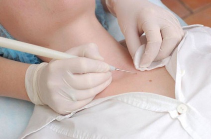 Hemangioma lábán, ami azt eredményezi, és a kezelés (kezelés) Hemangioma lábán, ami azt eredményezi, és a kezelés