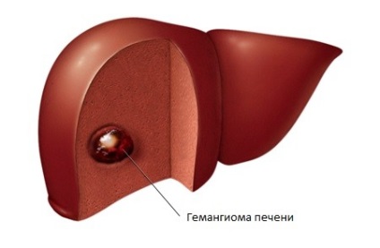 Hemangioma, a máj - a formák, okok, tünetek, kezelés