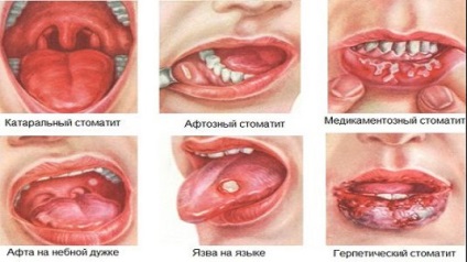 Gennyes stomatitis - Kezelés és tüneteket okoz