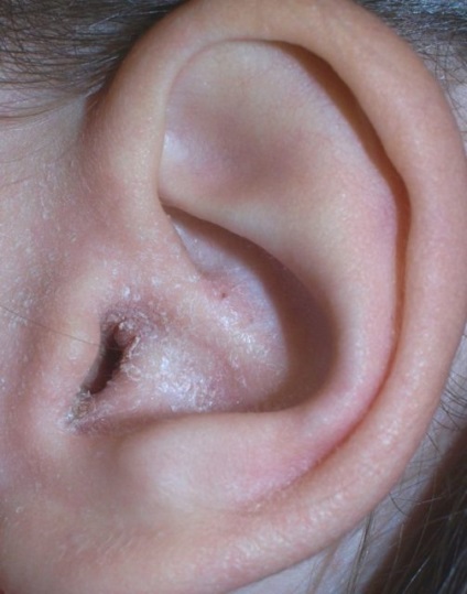 A gomba a füle okok, tünetek, diagnózis, kezelés