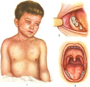 Fertőzés (vírus) tünetei és kezelése dermatitis gyermekeknél és felnőtteknél