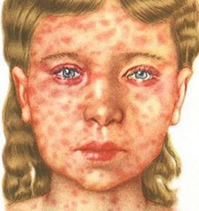 Fertőzés (vírus) tünetei és kezelése dermatitis gyermekeknél és felnőtteknél
