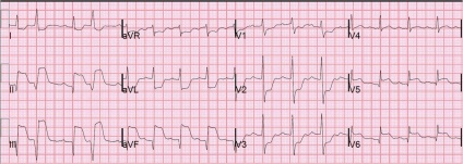 Ischaemiás EKG iszkémiás változások és jelei (szívkoszorúér-betegség) Ischaemiás EKG iszkémiás és jeleket