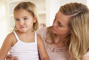 Meddig kezeljük bárányhimlő gyermekeknél, bárányhimlő gyermekeknél