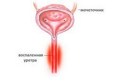 Candida húgycsőgyulladás női kezelés okai és megelőzése