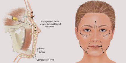 Lipofilling arc, mellkas és a fenék ár és a funkciók az eljárás