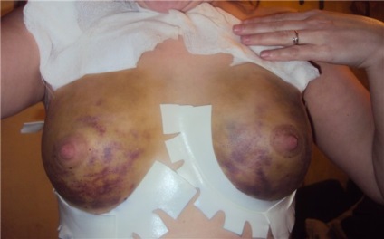 Lipofilling rehabilitáció, komplikációk után lipofilling emlő, arc, fenék, alsó szemhéj (lipofilling arc rehabilitáció) Lipofilling rehabilitáció, szövődmények lipofilling mell, arc, fenék, alsó szemhéj