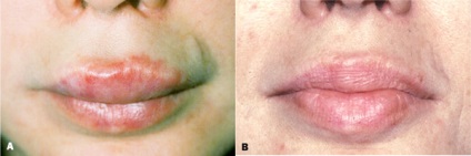 Lipofilling rehabilitáció, komplikációk után lipofilling emlő, arc, fenék, alsó szemhéj (arc) Lipofilling rehabilitáció, szövődmények lipofilling mell, arc, fenék, alsó szemhéj