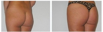 Lipofilling rehabilitáció, komplikációk után lipofilling emlő, arc, fenék, alsó szemhéj (utáni rehabilitáció lipofilling) Lipofilling rehabilitáció, szövődmények lipofilling mell, arc, fenék, alsó szemhéj