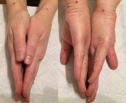 Lipofilling rehabilitáció, komplikációk után lipofilling emlő, arc, fenék, alsó szemhéj (fenék) Lipofilling rehabilitáció, szövődmények lipofilling mell, arc, fenék, alsó szemhéj