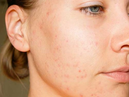távolítsa el a vörös foltokat az arcról népi gyógymódokkal psoriasis symptoms skin