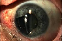 Melanoma a szem - okai, tünetei, diagnózisa és kezelése
