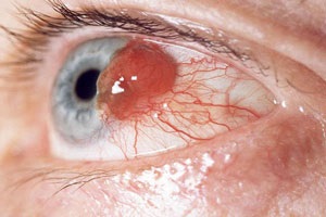 Melanoma a szem - tünetek, kezelés okozza, fotó