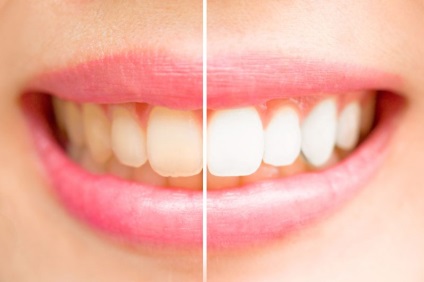Lehetséges, hogy fehéríti a fogakat fémkerámia módszerek és ajánlások