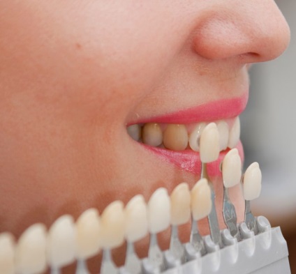 Lehetséges, hogy fehéríti a fogakat fémkerámia módszerek és ajánlások