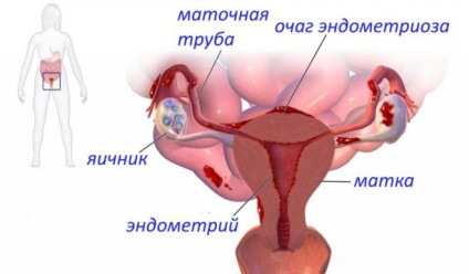 Kaphatok terhes endometriózis