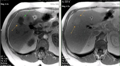 MR szakértői MRI diagnózis májbetegségek (máj) Szakértő MRI, MRI diagnózis májbetegségek