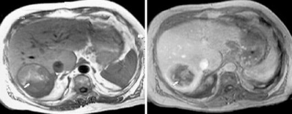 Szakértő MRI, MRI diagnózis májbetegségek