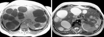 Szakértő MRI, MRI diagnózis májbetegségek