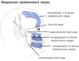 Neuropathia a háromosztatú ideg, okairól és kezeléséről