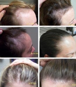 Kopaszság és hajhullás a férfiak és a nők okok és kezelések, hajátültetés