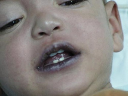 Obstruktív bronchitis kezelt gyermekeknél népi jogorvoslati