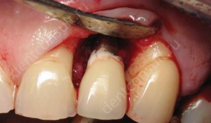 A fő oka az elutasítás a fogászati ​​implantátumok