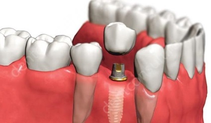A fő oka az elutasítás a fogászati ​​implantátumok