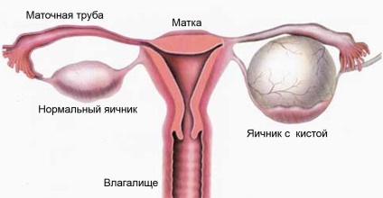Pathology luteális elégtelenség, perzisztencia és ciszták rés (patológia) sárga test patológia meghibásodása, perzisztencia és ciszta szakadás