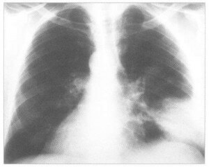 Pneumonia macskáknál tünetek és a kezelés veszélyes betegségek (tüdőgyulladás) Pneumonia macskáknál tünetek és a kezelés veszélyes betegségek