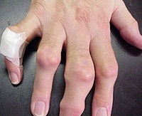 köszvényes izületi gyulladás a kezén fájdalom a medenceízületben hogyan kell kezelni