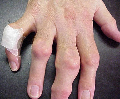 Köszvény a kezében egy ügynök kezelésére köszvényes arthritis a kéz és az ujjak