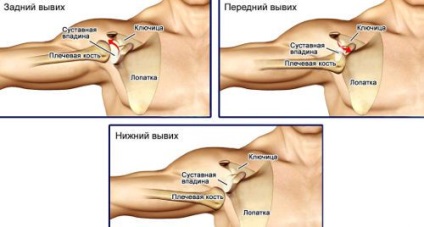 Subluxatio a vállízület, váll subluxation tünetek