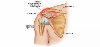 Subluxatio a vállízület, váll subluxation tünetek