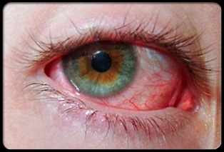 Bőrpír a szemgolyó a betegség tünetei