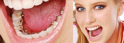 Tedd fogszabályozó fogak elrontani miért vannak komplikációk után zárójelek