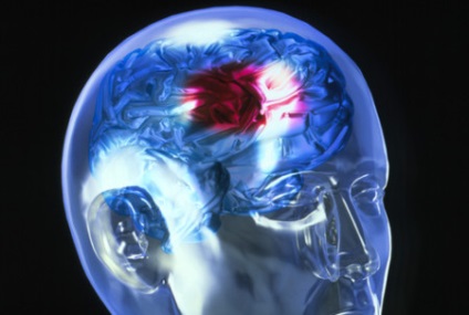 Ismétlődő stroke következményei és okai kiújulás (következmények) Ismétlődő stroke következményei és okai visszaesés