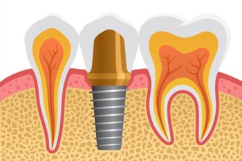 A túlélési arány a fogászati implantátumok (megfeleljenek ennek az ajánlásnak az orvos) A túlélési arány a fogászati implantátumok