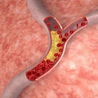 Jelei transmurális infarktus EKG (transmuralis) Jelei transmurális infarktus EKG