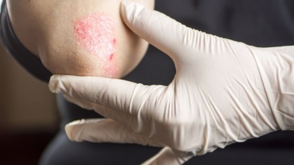 Psoriasis a könyök kezelés (pikkelysömör kezelésére könyök) Psoriasis a könyök kezelés