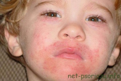 Psoriasis gyermekeknél, fotó kezdeti szakaszában, a tünetek, az okok a betegség (elsődleges) Psoriasis gyermekeknél, fotó korai szakaszában, a tünetek, betegséget okoz