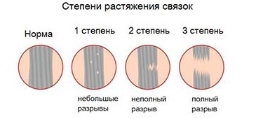 Розтягування пахових зв'язок симптоми, лікування