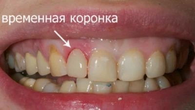 Fajták ideiglenes fogpótlás az első fogak és azok jellemzői (ideiglenes fogsort) Fajták ideiglenes fogpótlás az első fogak és azok jellemzői