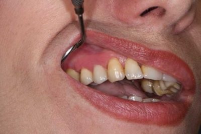 Fajták ideiglenes fogpótlás az első fogak és azok jellemzői (ideiglenes fogsort) Fajták ideiglenes fogpótlás az első fogak és azok jellemzői