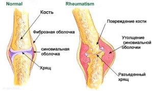 Reuma - okai, tünetei és népi jogorvoslati reuma kezelésére