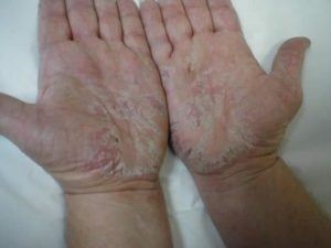 Tünetei és okai dermatitis a tenyér
