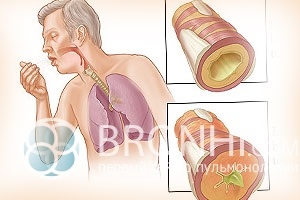 Hány nap kezelik akut és krónikus bronchitis