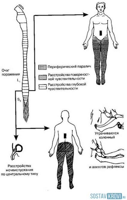 Spinal sztrók okai, tünetei, kezelése és prognózisa a stroke